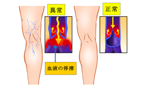 下肢静脈瘤とは