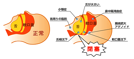 睡眠時無呼吸症候群（SAS）の原因