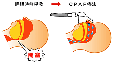 睡眠時無呼吸症候群（SAS）の治療