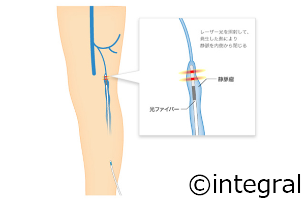 レーザー治療 治療方法