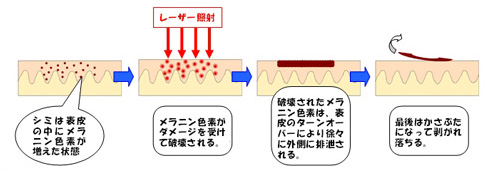 レーザー治療のメカニズム