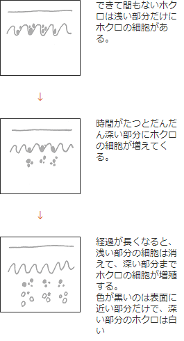 ホクロの時間経過による変化