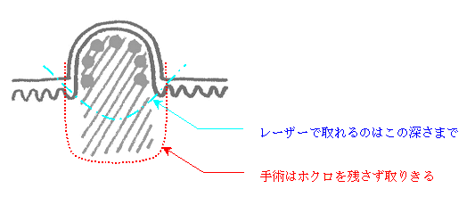 タバコ 縫合