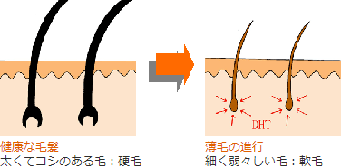 AGAの原因