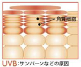 紫外線による炎症