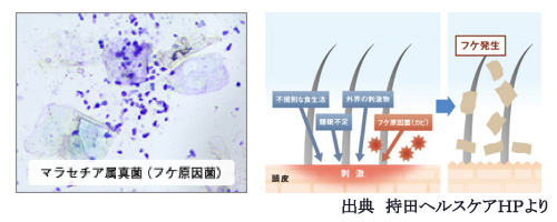 フケ・かゆみの原因と発生メカニズム