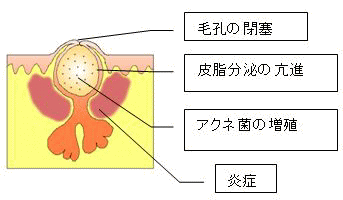 ニキビの発生