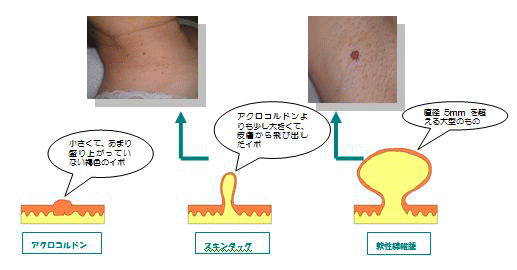 首イボの種類