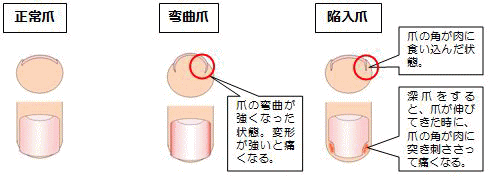 陥入爪・巻き爪 - ひまわり皮フ科 | 江東区亀戸駅徒歩2分