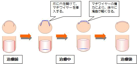 爪矯正（マチワイヤー法）