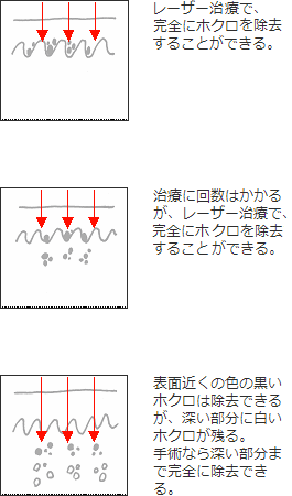 ホクロの治療効果